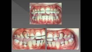 twin block Activator Orthodontist [upl. by Milty]