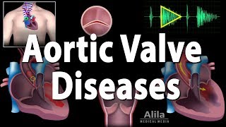 Aortic Valve Disease Animation [upl. by Oilerua]