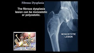 Fibrous Dysplasia  Everything You Need To Know  Dr Nabil Ebraheim [upl. by Ecitnerp]