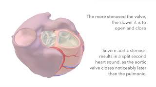 Aortic Stenosis  Murmur Sound amp Animation [upl. by Burget]