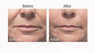 Botox vs Dermal Fillers [upl. by Fong]