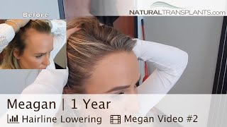 Female Hairline Lowering Hair Transplant 1 Year After  Dr Matt Huebner Meagan [upl. by Vudimir]