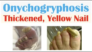 How to Deal with Nail Fungus Part 2  Onychomycosis [upl. by Hyacinthia]