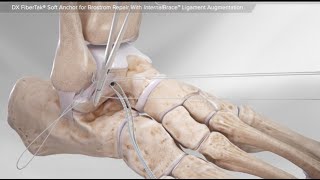 DX FiberTak® Soft Anchor for Brostrom Repair With InternalBrace™ Ligament Augmentation [upl. by Utas]