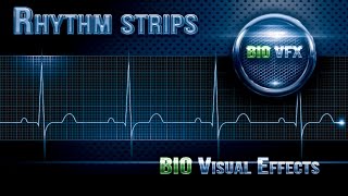 ECG or EKG Rhythm Strips part 1 [upl. by Ferris]