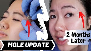 Facial Mole Removal Healing Process  2 Month Update  Regrets  Mole Shaving Experience [upl. by Pauli564]