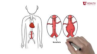 What is an abdominal aortic aneurysm [upl. by Aicilihp]