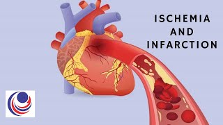 Ischemia and Infarction The difference and Similarities [upl. by Golanka]