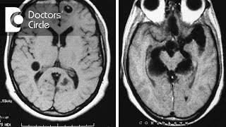 What do granuloma with Neurocysticercosis amp Tuberculoma in MRI brain signify  Dr Vykunta Raju K N [upl. by Enilaf]