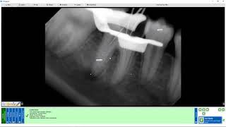 Training Apteryx XrayVision DCV Image Calibration and Measurement [upl. by Arait670]