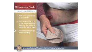 ColostomyIleostomy Changing a Pouch [upl. by Khudari]