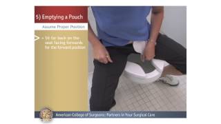 ColostomyIleostomy Emptying a Pouch [upl. by Aicak]