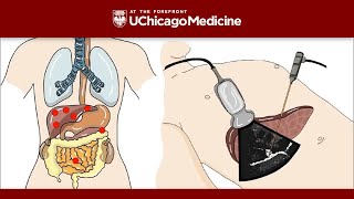 Neuroendocrine Tumors – An Introduction [upl. by Narine71]