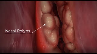 Nasal Polyps diagnosis and treatment options [upl. by Meensat47]