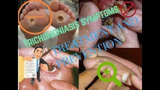 Trichomoniasis symptomsTreatment and Prevention [upl. by Caterina982]