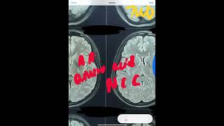 MRI BRAIN  TUBERCULOMA VS NCC [upl. by Samanthia53]