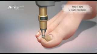 ClearChoice a dual laser approach to onychomycosis from Alma Lasers [upl. by Renault]