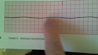 Agonal and Asystole [upl. by Dovev]