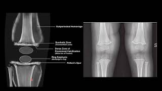 SCURVY VS RICKETS RADIOLOGY [upl. by Ecnaralc]