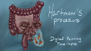 Hartmanns Procedure  Digital Painting Timelapse [upl. by Mara]