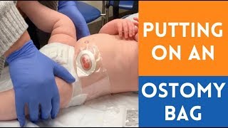 Applying an Ostomy Bag [upl. by Lowson]