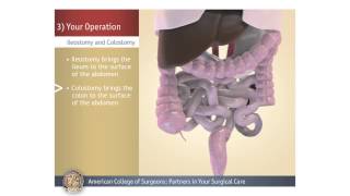 ColostomyIleostomy Your Operation [upl. by Lleinnad]