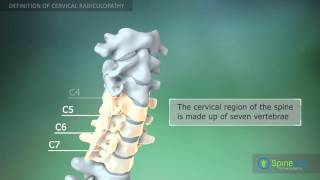 CERVICAL STENOSIS RADICULOPATHY  PART 3  SURGICAL OPTIONS [upl. by Eirok]