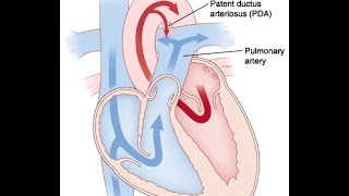 Patent Ductus Arteriosus [upl. by Storer805]