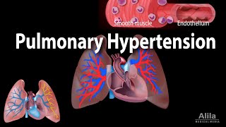 Pulmonary Hypertension Animation [upl. by Sharline]