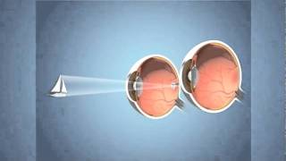 Monovision for Presbyopia [upl. by Hulton251]