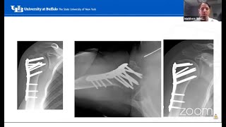 Proximal humerus fractures [upl. by Taimi]