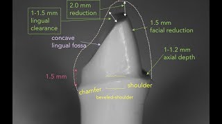 Anterior PFM Preparation  Dr Richard Stevenson [upl. by Talich232]