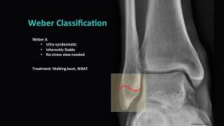 Distal Fibula Fractures [upl. by Dorcy319]