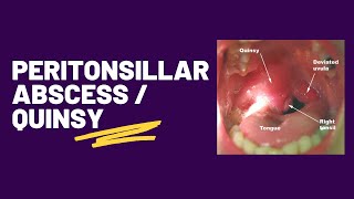 Peritonsillar abscess  Quinsy [upl. by Leiso]