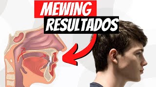 MEWING Resultados  ¿CUÁNTO TARDA [upl. by Ruy242]