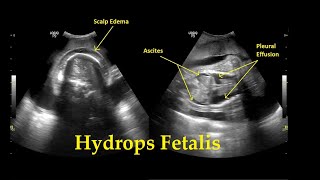 Hydrops Fetalis  Ultrasound  Anomaly  Case 26 [upl. by Teplitz473]