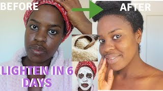 HOW I GOT RID OF DARK SPOTS BRIGHTEN DULL SKIN  HYPERPIGMENTATION [upl. by Nirok]