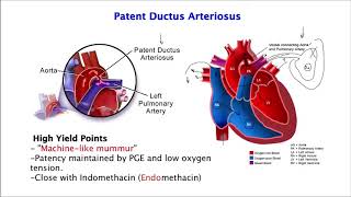 Heart SoundsPatent Ductus Arteriosus [upl. by Ramilahs413]