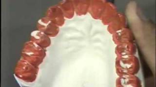 Occlusal Adjustment  Protrusive Movement [upl. by Hatti105]