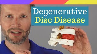 Explained Degenerative Disc Disease [upl. by Engis]