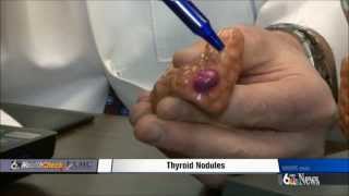 Thyroid Nodules [upl. by Mellman]