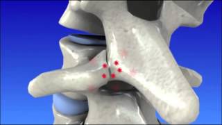 Degenerative Disc Disease  Spine Degeneration [upl. by Wampler]