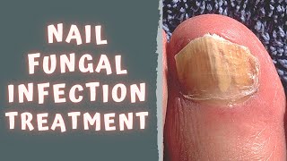 HOW TO TREAT FUNGAL NAIL INFECTION  TINEA UNGUIUM  ONYCHOMYCOSIS [upl. by Kilgore936]