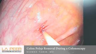 Colon Polyp Removal During Colonoscopy  Los Angeles La Peer Surgery Center [upl. by Ynohtnaed]