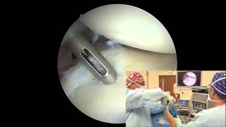 Arthroscopic Posterior Labral Repair  Randy S Schwartzberg MD [upl. by Yellehs667]