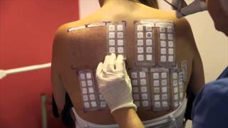 Skin Allergy Testing Using Patch Tests [upl. by Refinnej383]