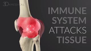 Immunology of the rheumatoid joint [upl. by Vasya409]