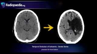 Stroke Evolution from acute to chronic infarction  radiology video tutorial CT MRI [upl. by Millda]