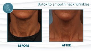 Botox To Lift Neck And Smooth Wrinkles [upl. by Kayley828]