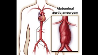 Abdominal Aortic Aneurysm AAA [upl. by Derwood]